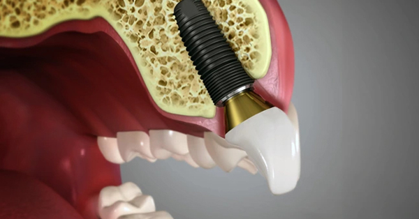 Can You Get Dental Implants in Grand Prairie if You Have Gum Disease?