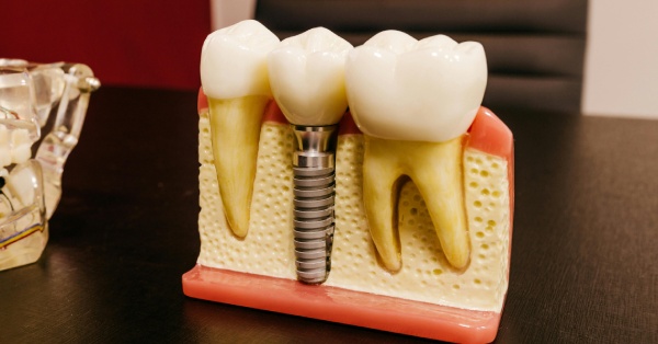 How to Maintain Dental Implants in Grand Prairie | Expert Tips