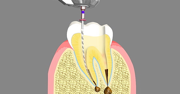 Top 7 Benefits of Root Canal Treatment in Grand Prairie