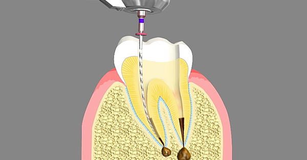 Two-Visit Procedure: Root Canal in Grand Prairie